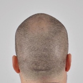 FUE Hair Transplant